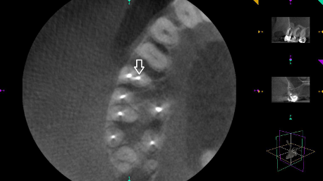 3D CT image after missed tissue was found and treated