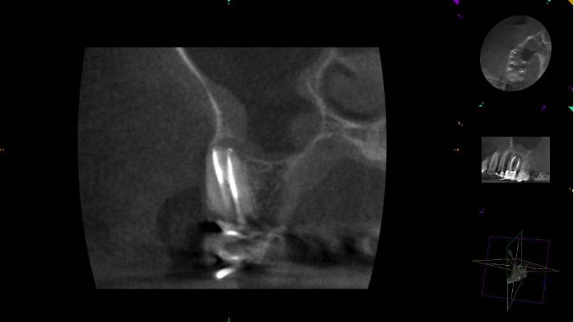3D CT scan after retreatment with completed root canal