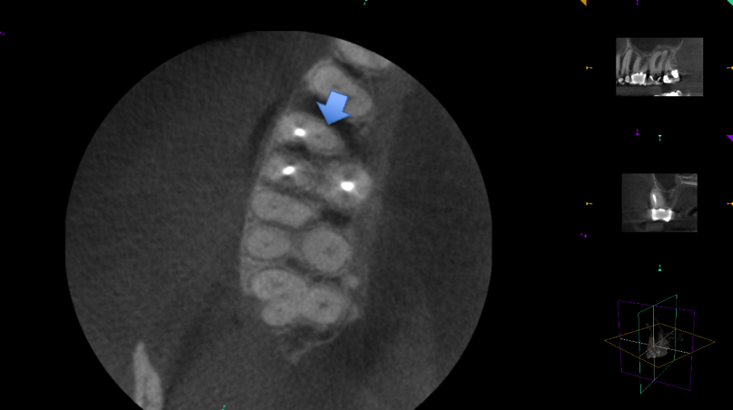 3D CT scan showing missed tissue before treatment