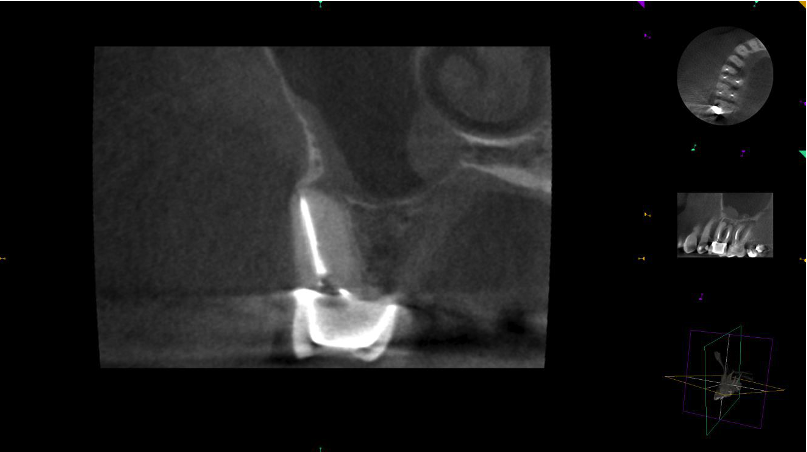 3D CT scan before retreatment