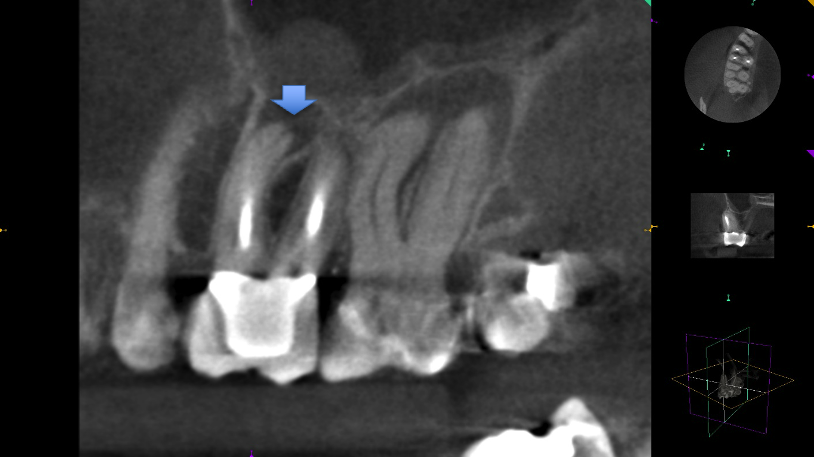 3D CT scan showing hidden infection at the root tip